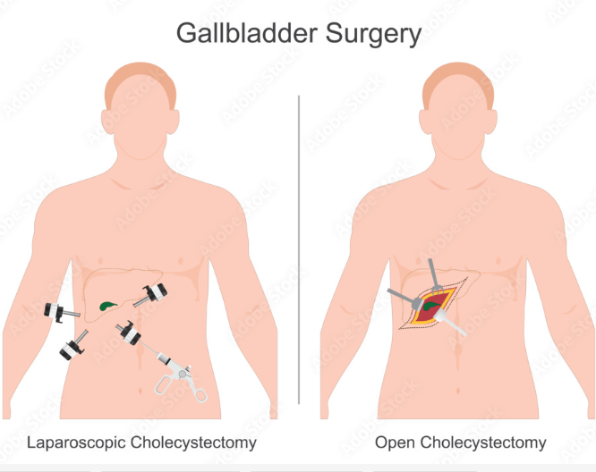 Best Gall Bladder Surgeon in Tardeo.